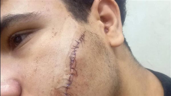 إصابة طالب بإحدى المدارس الصناعية